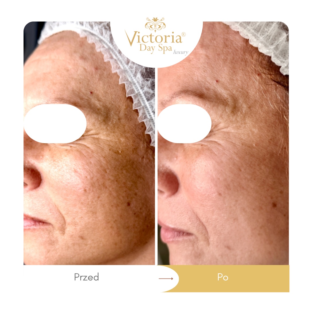 Green Sea Peel – policzek, przed i po