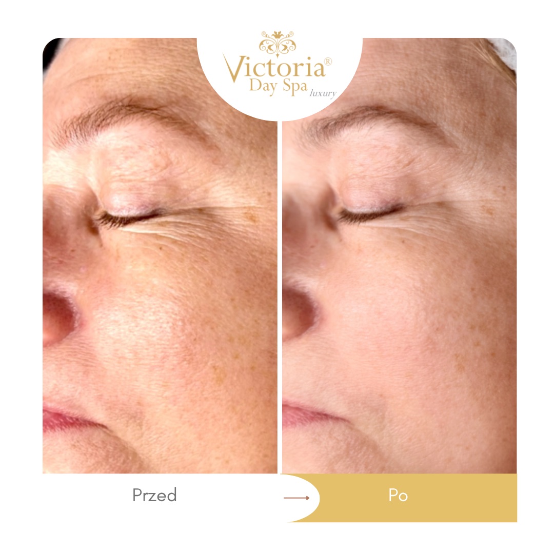 Green Sea Peel – okolica oka, przed i po